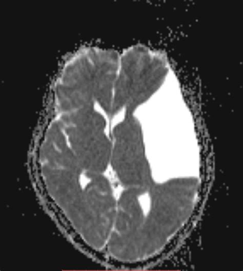 Large Fronto Temporal Arachnoid Cyst Image