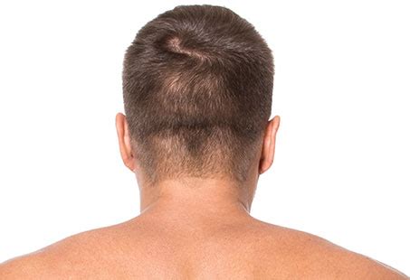 Hair Loss At The Nape Of The Neck Causes Treatments