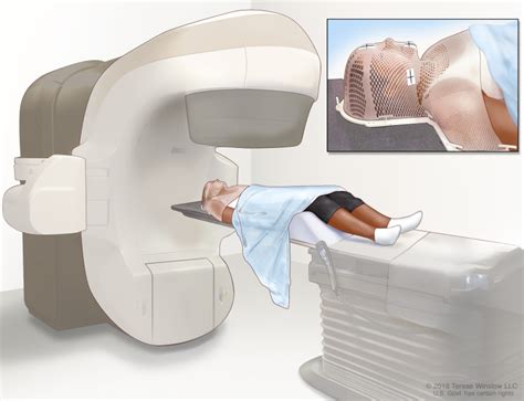 Figure External Beam Radiation Therapy Of The PDQ Cancer