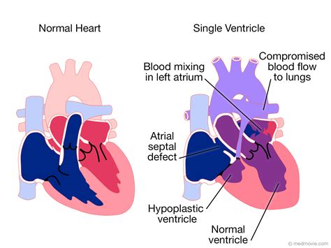 Single Ventricle