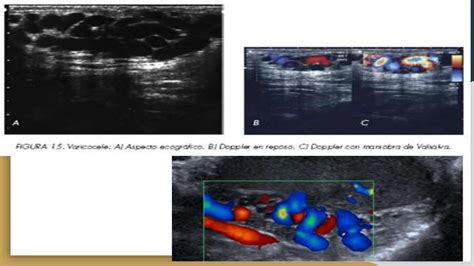 Hidrocele Y Varicocele En Imagenologia Radiologica Ppt Descarga