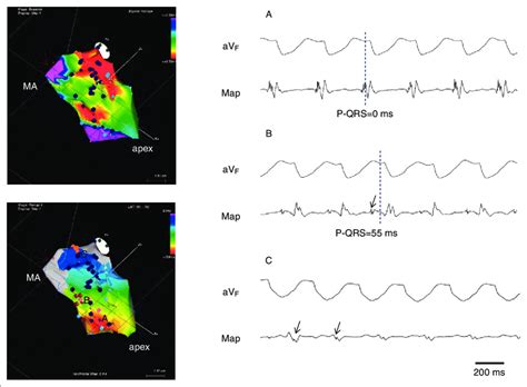 The Electroanatomical Maps Of The Left Ventricle During Sinus Rhythm