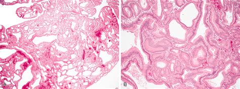 Epithelial Neoplasms Of The Small Intestine Clinical Tree