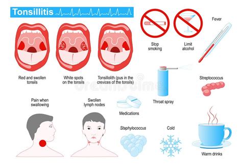 Signs And Symptoms Of Tonsillitis