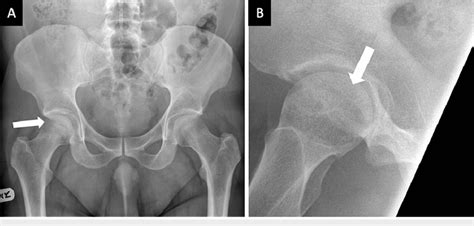 Anteroposterior A And Lateral B Pelvic Radiographs Of The Right Hip