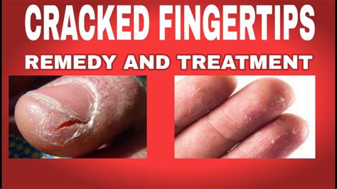 CRACKED FINGERTIPS REMEDY | HOW TO HEAL CRACKED FINGERTIPS,SKIN CARE ...