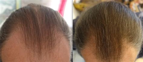 3 Months Minoxidil And Microneedlng Weekly Photo Wrassman M D