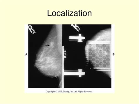 Ppt Mammography 2 Powerpoint Presentation Free Download Id 4110986