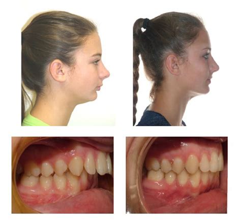 Before And After Overjet Profile