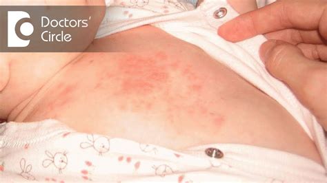 Itchy Rash On Stomach Belly Button Rash Causes And Symptoms Medicaverse A Rash Is A