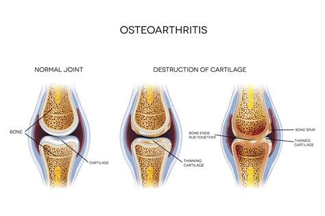 Arthritis is not a wear-and-tear problem | | The Body Mechanic®