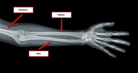 Radius And Ulna Labeled