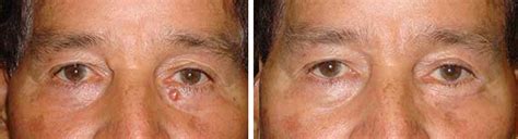 Eyelid Skin Cancer Surgery And Reconstruction Los Angeles