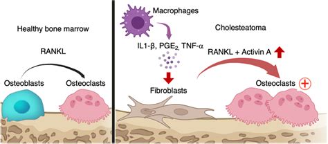 Schematic of osteoclastogenesis induced by cholesteatoma fibroblasts ...