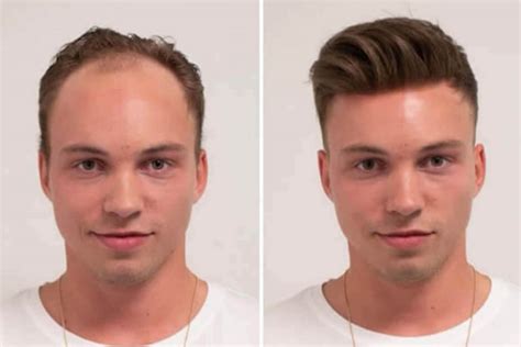 About Men’s Hair Replacement Maxwell Melia Academy