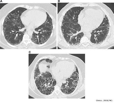 Imaging In Idiopathic Pulmonary Fibrosis Diagnosis And Mimics Clinics