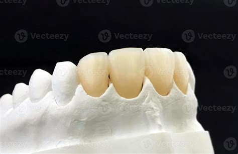 Dental Zirconia Crowns In The Plaster Model White Dental Veneers On