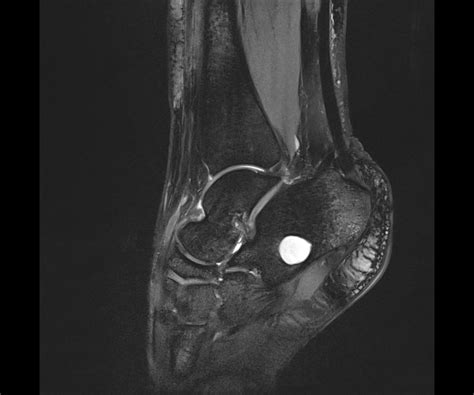 Calcaneal Simple Bone Cyst Image