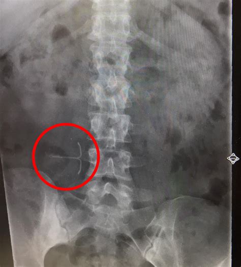 This Woman Had An Iud Floating Around Her Abdomen For 11 Years