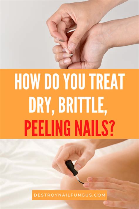 Peeling Fingernails Home Remedies And Preventive Measures