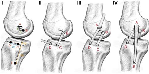 The “figure Of Four” Reconstruction Of The Medial Collateral Ligaments In The Setting Of