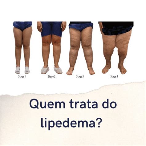 Quem Trata O Lipedema Dra Catarina Almeida