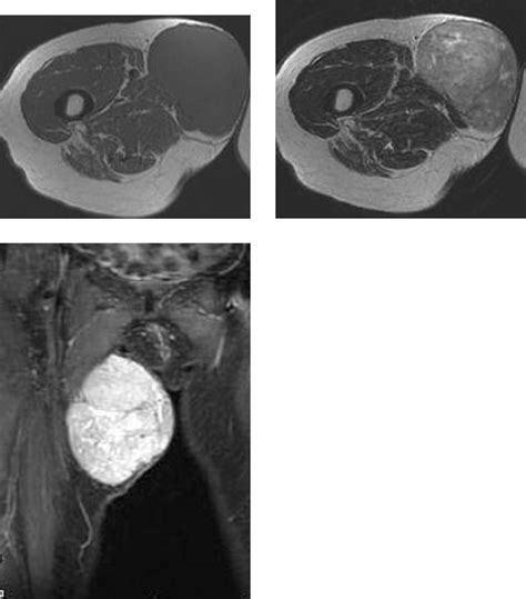 A 55 Year Old Woman With Leiomyosarcoma Of The Medial Right Upper