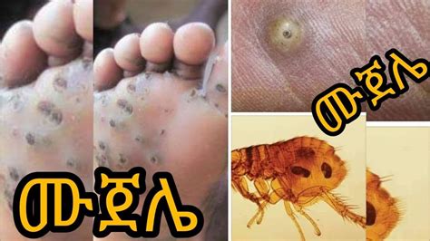 Defeatntds Tungiasis ሙጀሌ A Neglected Tropical Skin Disease By