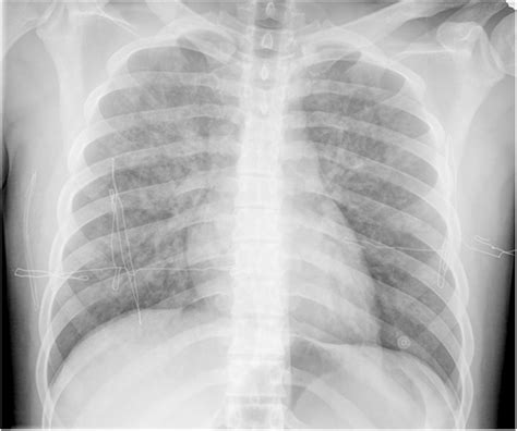 Chest Radiography Shows Bilateral Diffuse Pulmonary Infiltrates