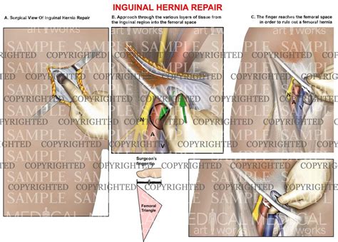 Inguinal hernia repair – Medical Art Works