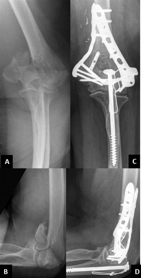 Preoperative Anteroposterior A And Lateral B Radiographic Traction