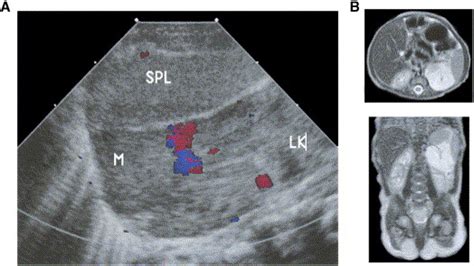 Retroperitoneal Hemangioma Of Infancy Journal Of Pediatric Surgery