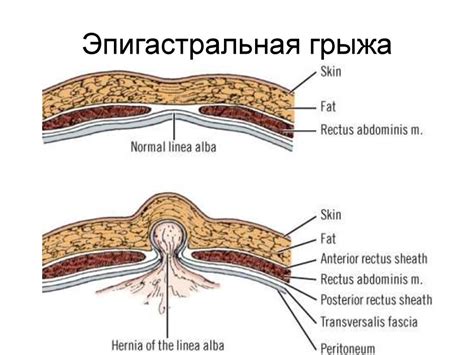 Грыжи. Составные элементы грыжи - презентация онлайн