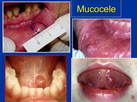 Salivary Glands Diseases