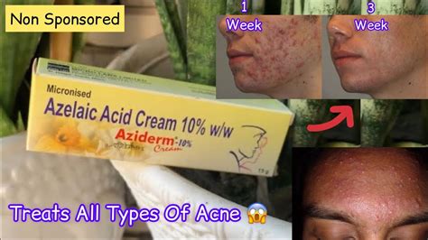 Aziderm 10 Cream Review Azelaic Acid Cream Review Youtube