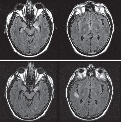 Paraneoplastic Neurologic Syndromes Clinical Tree