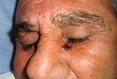 Basal Cell Carcinoma Causes Types Symptoms Prognosis Treatment