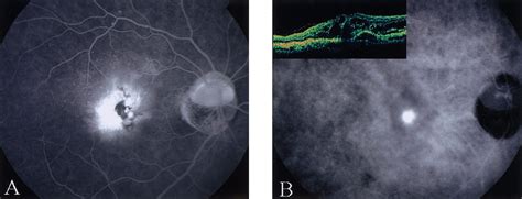 Recurrent Retinal Angiomatous Proliferation After Surgical Ablation