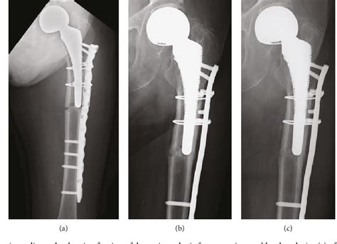 Figure 1 From Two Cases Of Periprosthetic Atypical Femoral Fractures In Patients On Long Term