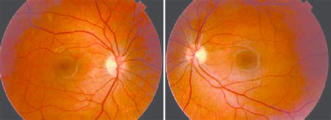 Literature Review Ophthalmologic Findings In Hepatitis C Patients Treated With Pegylated