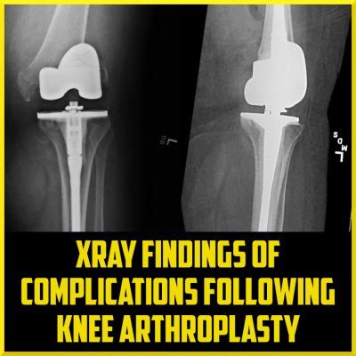 Imaging After Total Knee Arthroplasty Sports Medicine Review