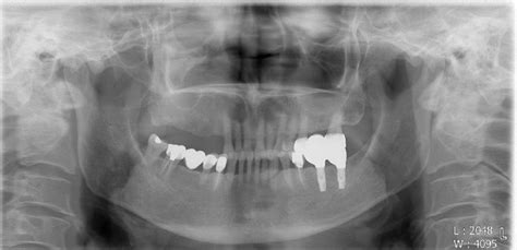 Panoramic Image Shows Similar Haziness Of The Right Maxillary Sinus