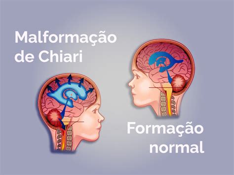 Escoliose Tor Cica O Que Saber Sobre Dr J Nio Alves Ferreira