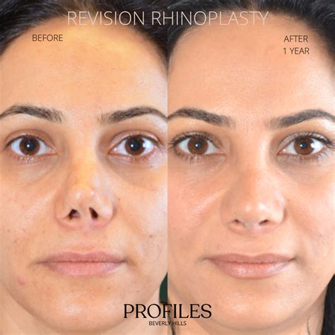 Revision Rhinoplasty Beverly Hills Revision Rhinoplasty Los Angeles