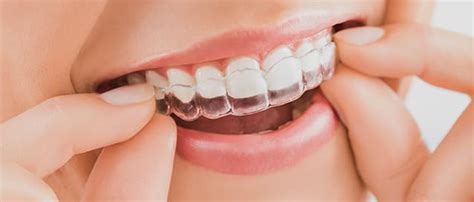 How To Choose Between Traditional Braces And Invisalign Toothworks