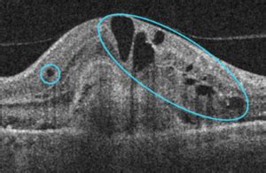 Macular OCT Interpretation 301 - EyeCarePD