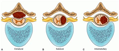 Spinal Cord Tumors Nurse Key