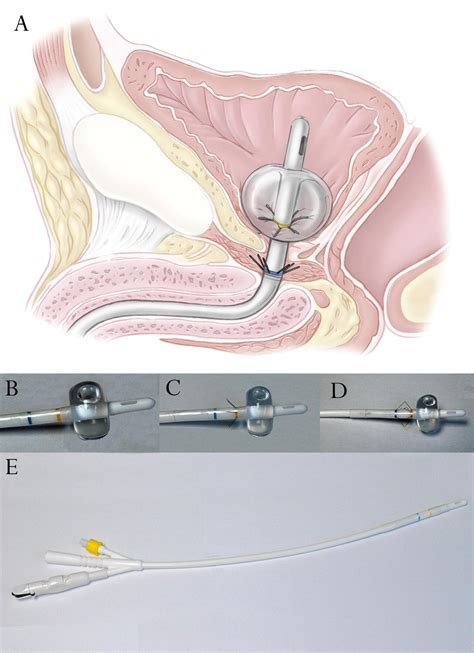 Comparison Of Novel Tissue Apposing Device And Standard Anastomotic