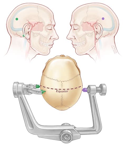 Neuro Three Pin Fixation pins - Surgical Technology
