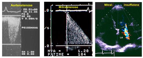 50 Jahre Ultraschall Des Herzens Mindcarb